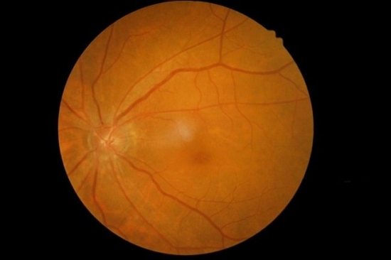 Fundus Retinal Photography image