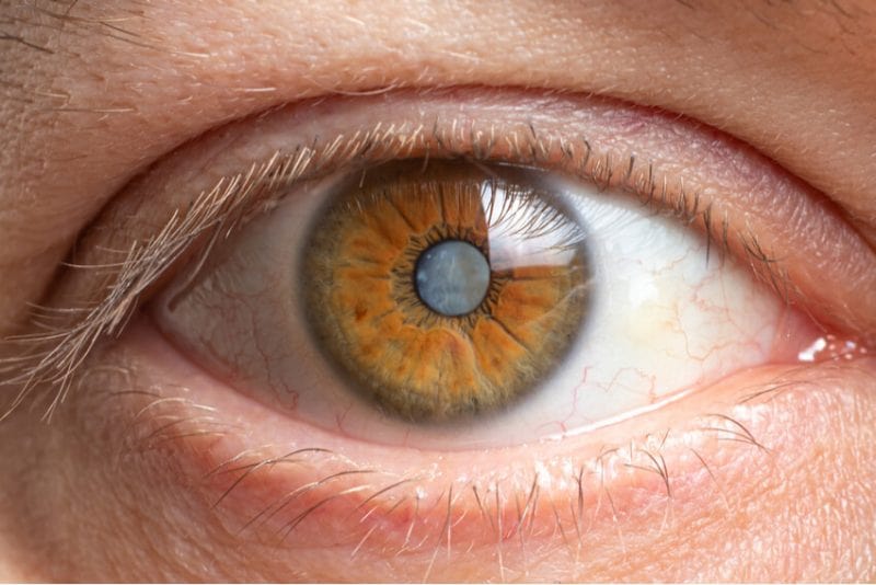 A close-up of a person's eye with an orange iris. Learn about cataracts this summer.
