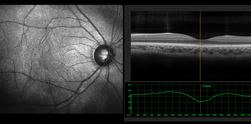 Eye and eye chart