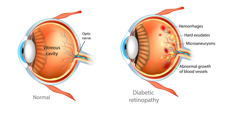 Image showing diabetic retinopathy and macular degeneration, highlighting eye conditions related to diabetes and age-related vision loss