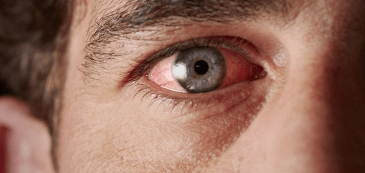 What Causes pink eye? | Dr Bruce Coward Optometrists